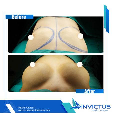 aesthetic-before-after-invictus2