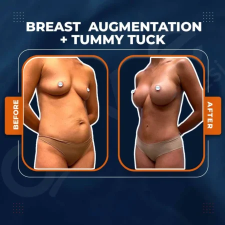 invictus-breast-augmentation-tummy-tuck-01