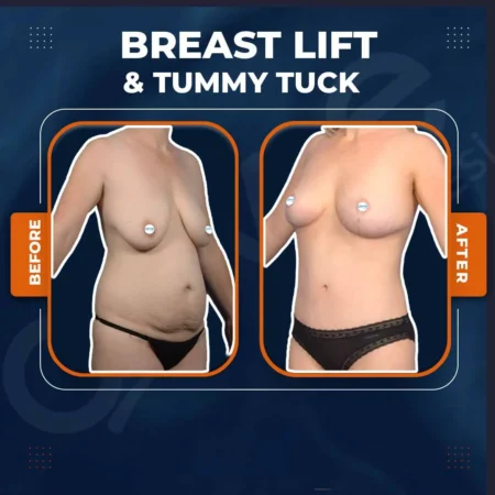 invictus-breast-lift-tummy-tuck-01