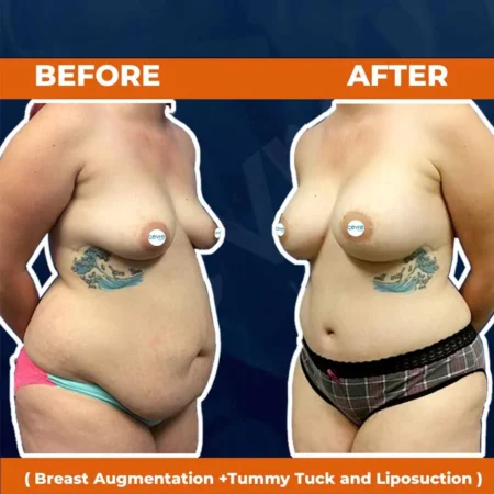 invictus-breast-lift-tummy-tuck-liposuction-01