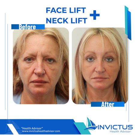 invictus-facelift-1