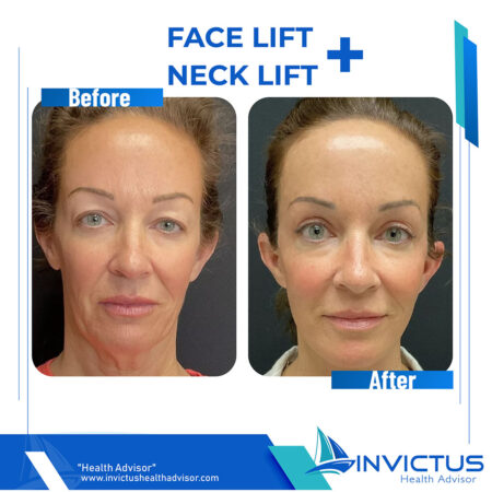 invictus-facelift-3