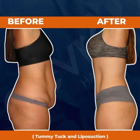 invictus-tummy-tuck-liposuction-01