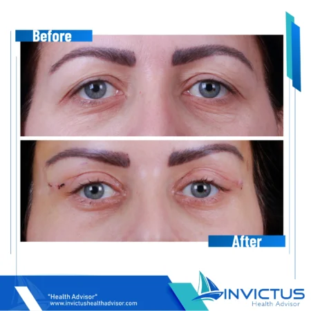 invictus-blefaroplasty-01