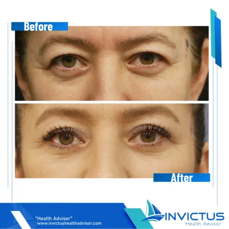 invictus-blefaroplasty-02