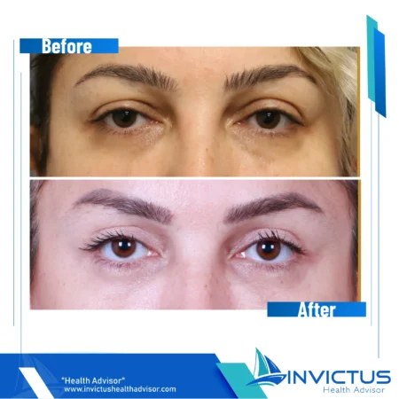 invictus-blefaroplasty-03