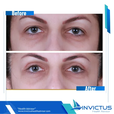 invictus-blefaroplasty-04