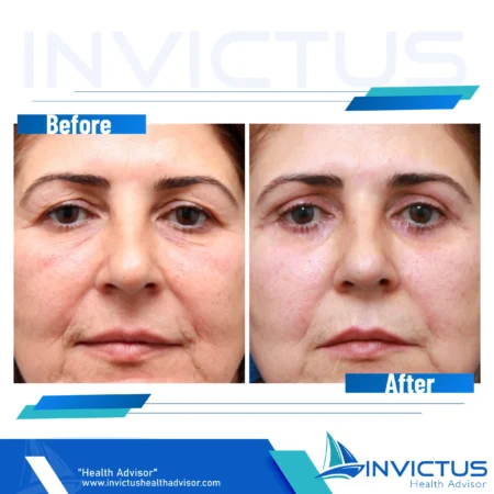 invictus-blefaroplasty-05