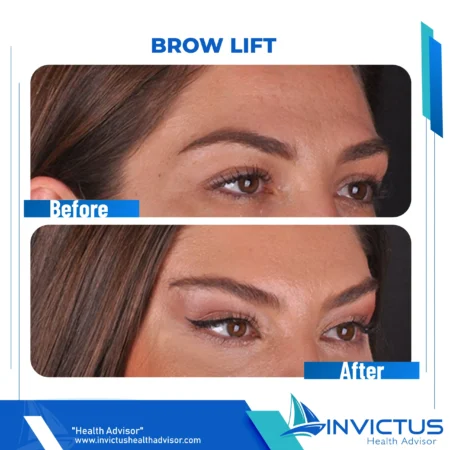 invictus-brow-lift-01