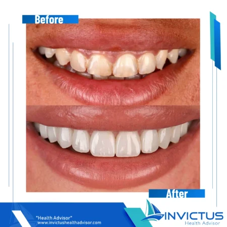 invictus-hollywood-smile-01