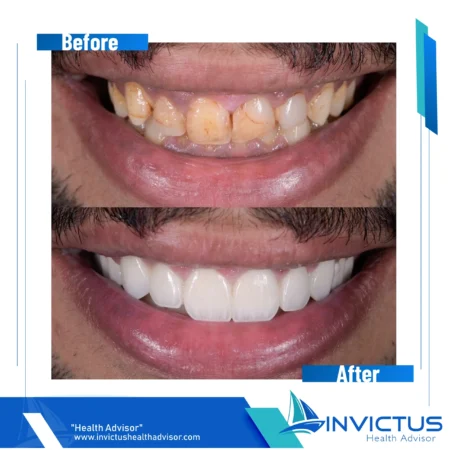 invictus-hollywood-smile-02