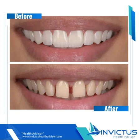 invictus-hollywood-smile-04