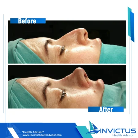 invictus-rhinoplasty-01