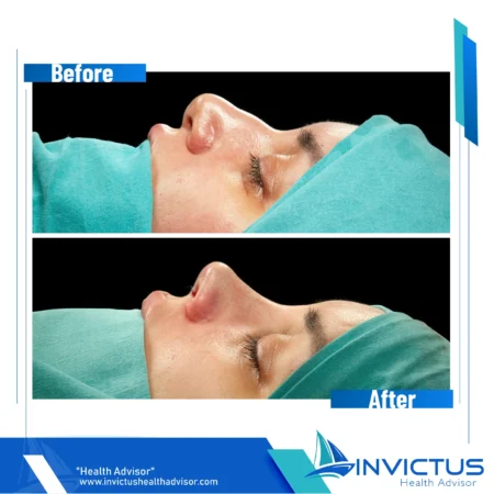 invictus-rhinoplasty-02