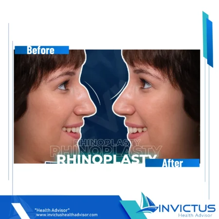 invictus-rhinoplasty-03