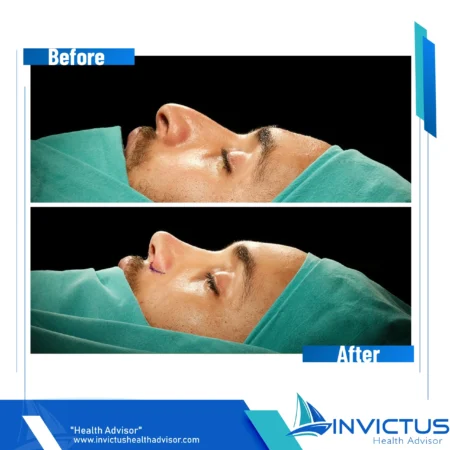 invictus-rhinoplasty-04