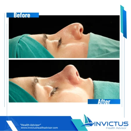 invictus-rhinoplasty-05