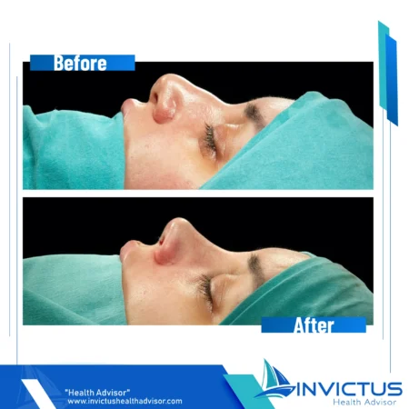 invictus-rhinoplasty-06