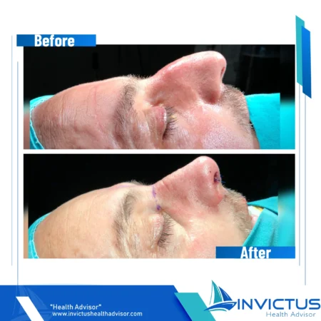 invictus-rhinoplasty-07