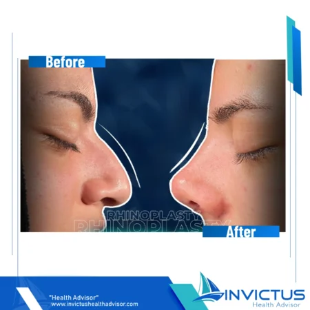 invictus-rhinoplasty-08