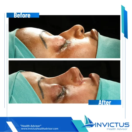 invictus-rhinoplasty-09