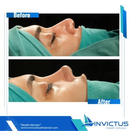 invictus-rhinoplasty-10