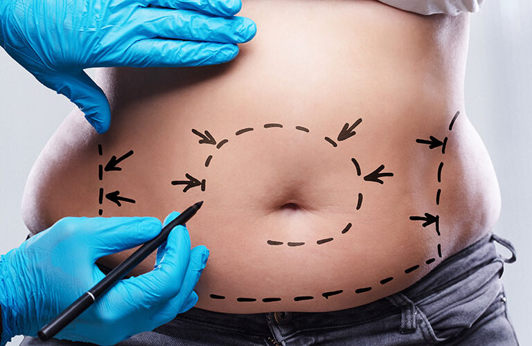 abdominoplasty